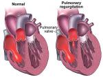 Best Treatment for Heart valve repair or replacement in India